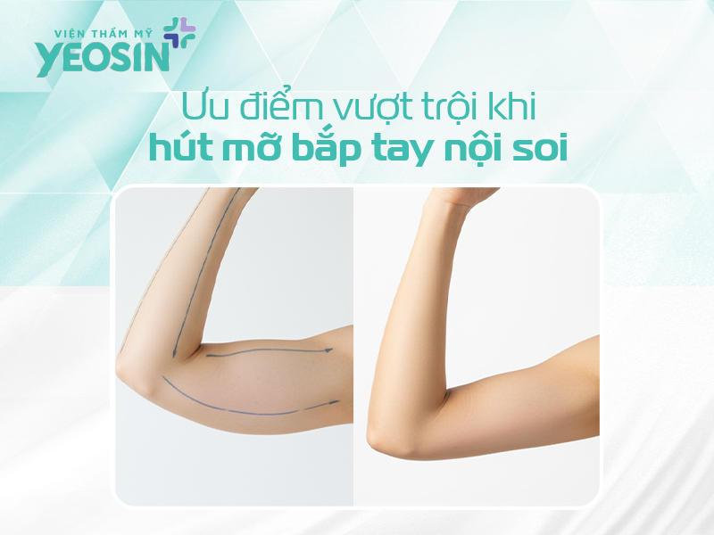 Ưu điểm vượt trội khi hút mỡ bắp tay nội soi.