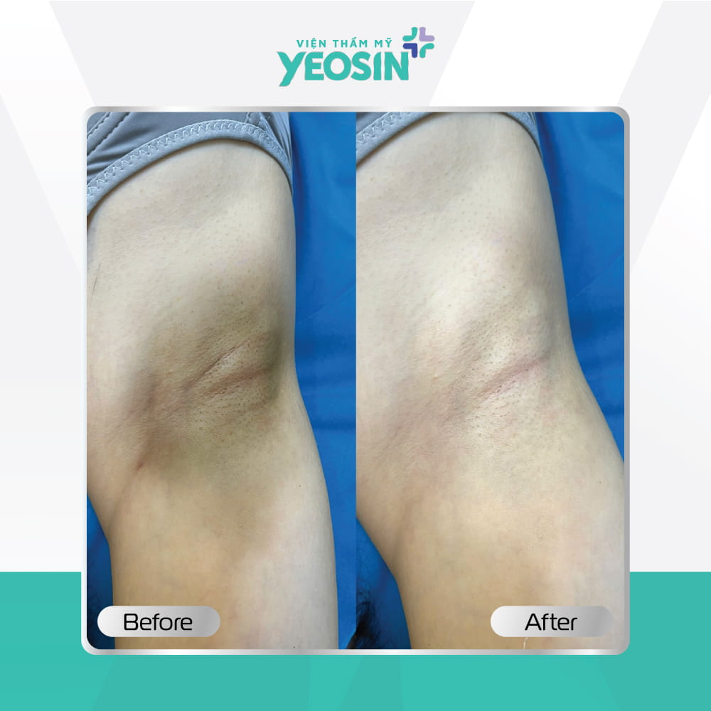 Hình ảnh trước và sau khách hàng trị thâm nách BIO-SKIN tại Viện Thẩm Mỹ Yeosin