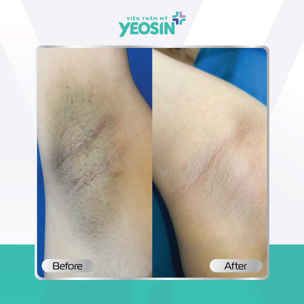 Hình ảnh trước và sau khách hàng trị thâm nách BIO-SKIN tại Viện Thẩm Mỹ Yeosin