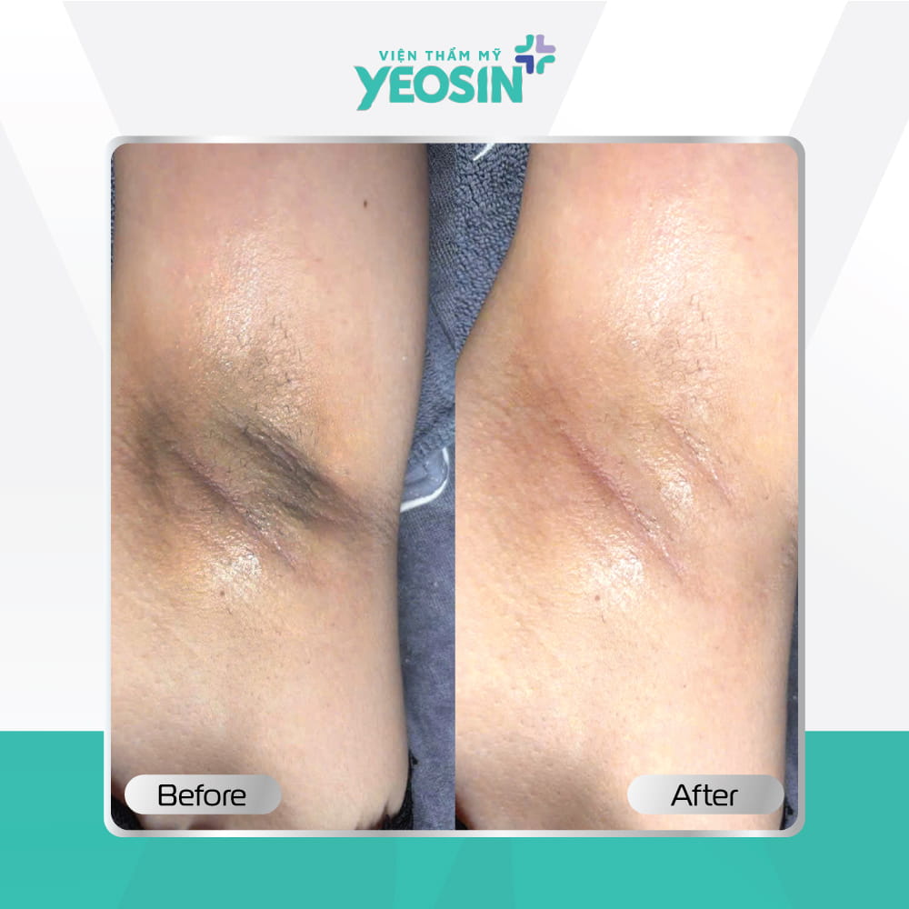 Hình ảnh trước và sau khách hàng trị thâm nách BIO-SKIN tại Viện Thẩm Mỹ Yeosin