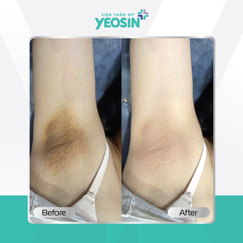 Hình ảnh trước và sau khách hàng trị thâm nách BIO-SKIN tại Viện Thẩm Mỹ Yeosin