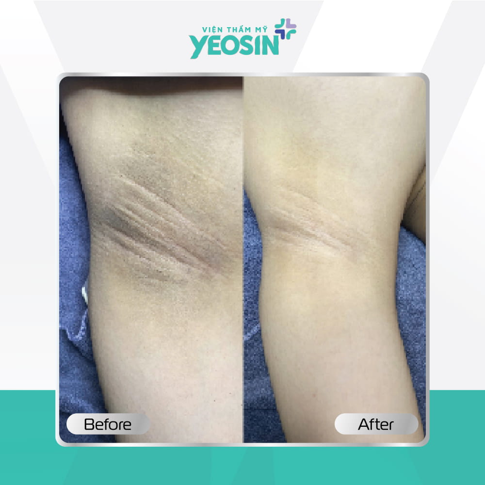 Hình ảnh trước và sau khách hàng trị thâm nách BIO-SKIN tại Viện Thẩm Mỹ Yeosin