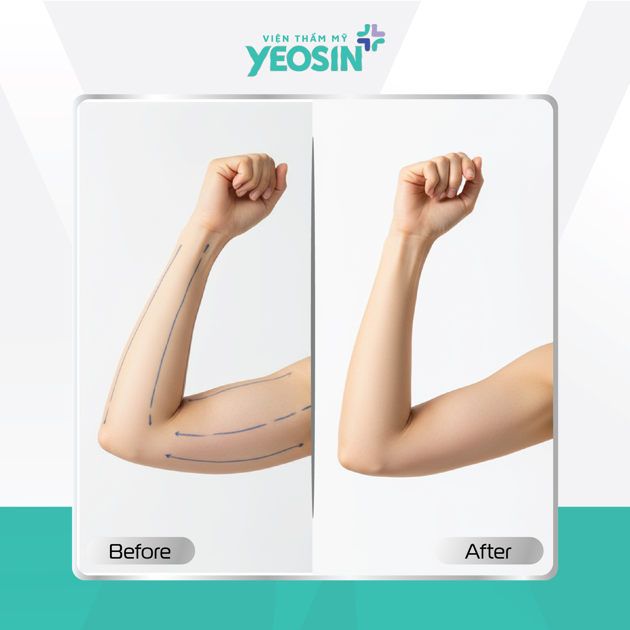 Hút mỡ bắp tay Yeosin