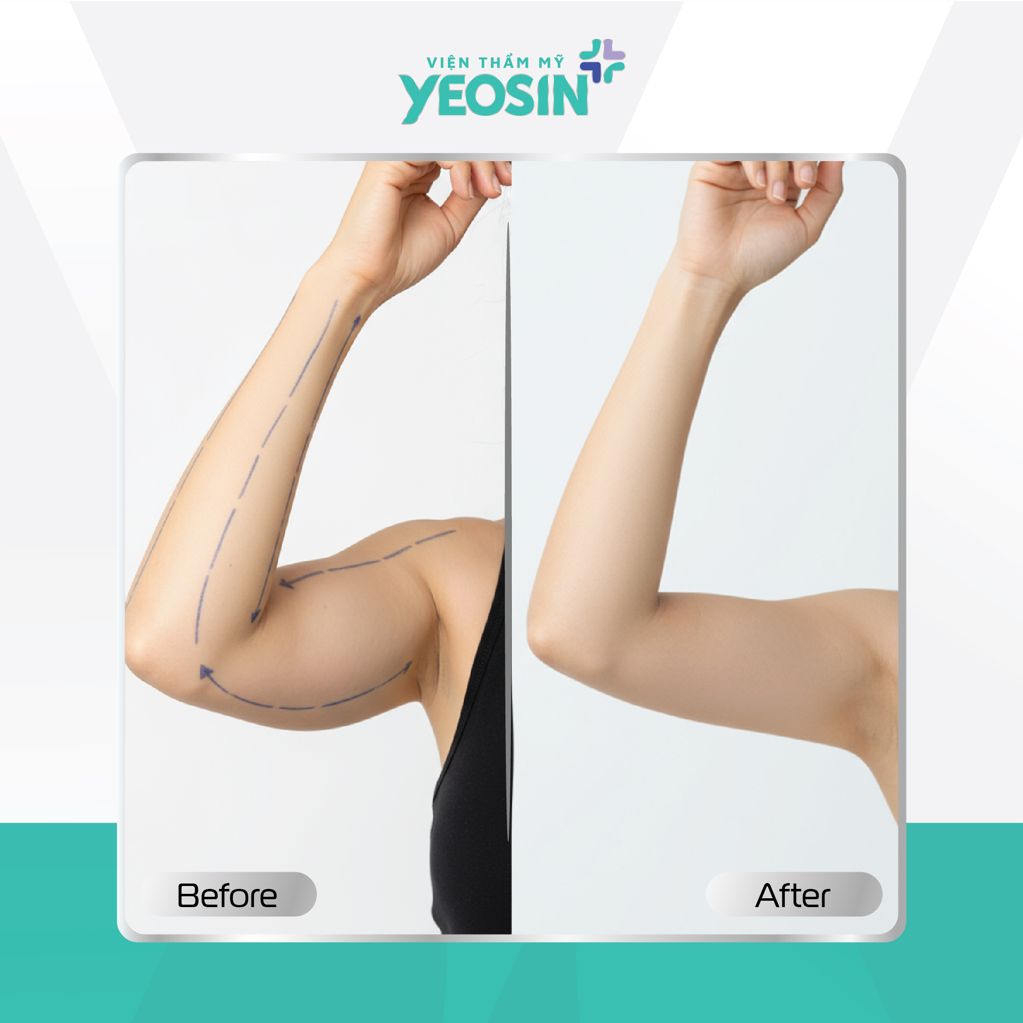 Hút mỡ bắp tay Yeosin