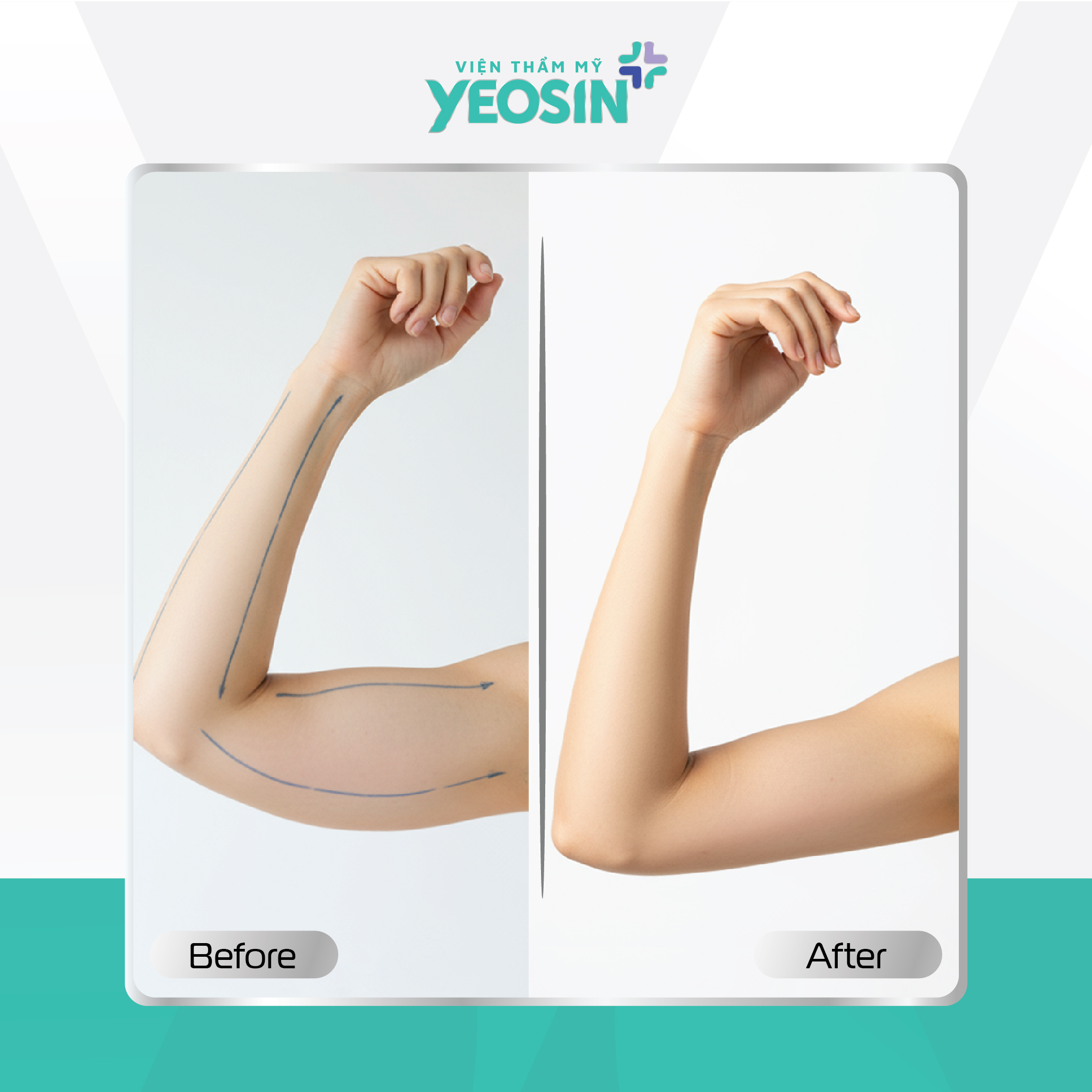 Hút mỡ bắp tay Yeosin