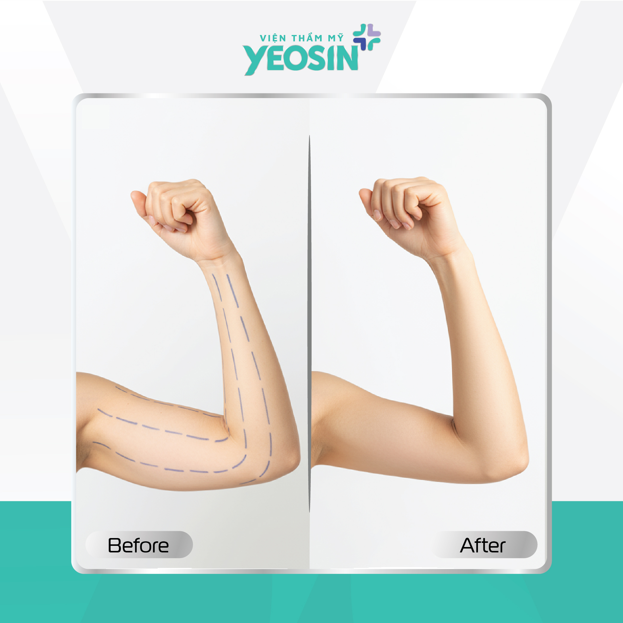 Hút mỡ bắp tay Yeosin