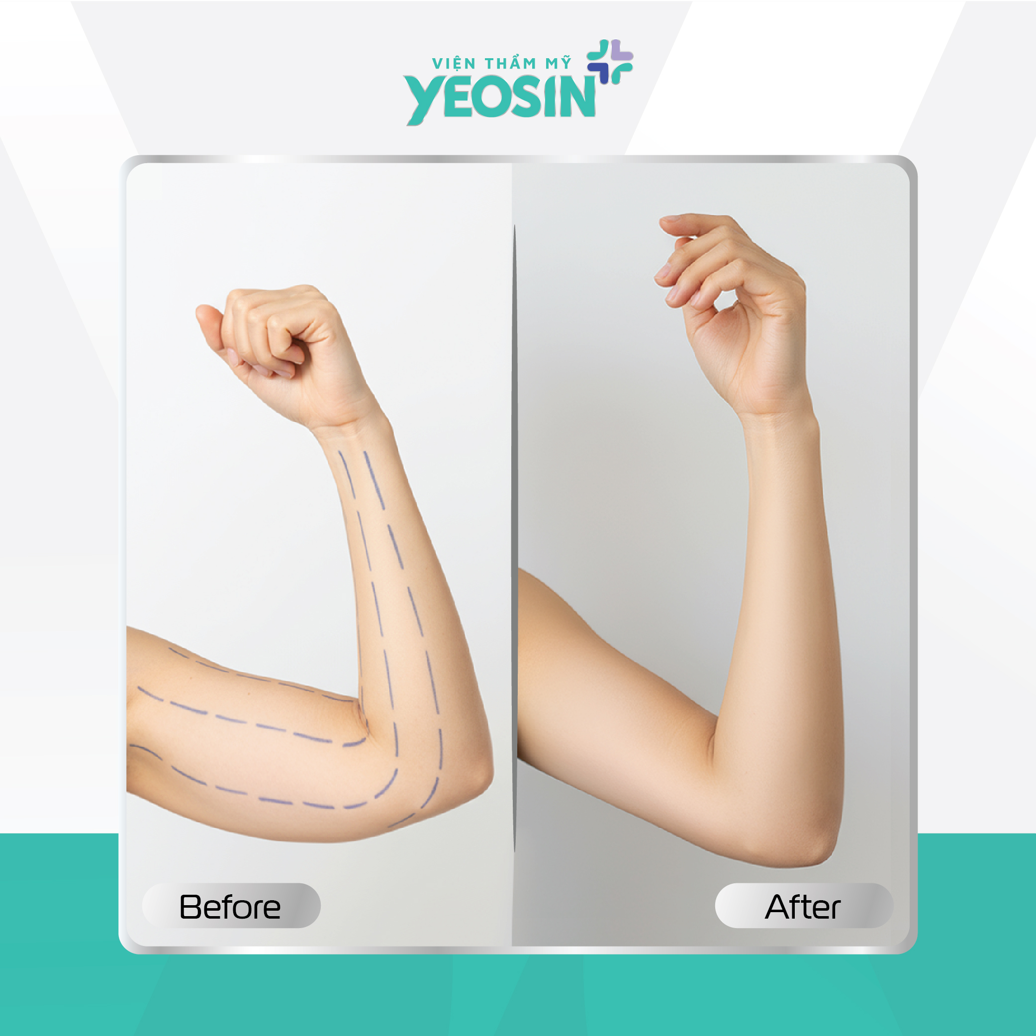 Hút mỡ bắp tay Yeosin