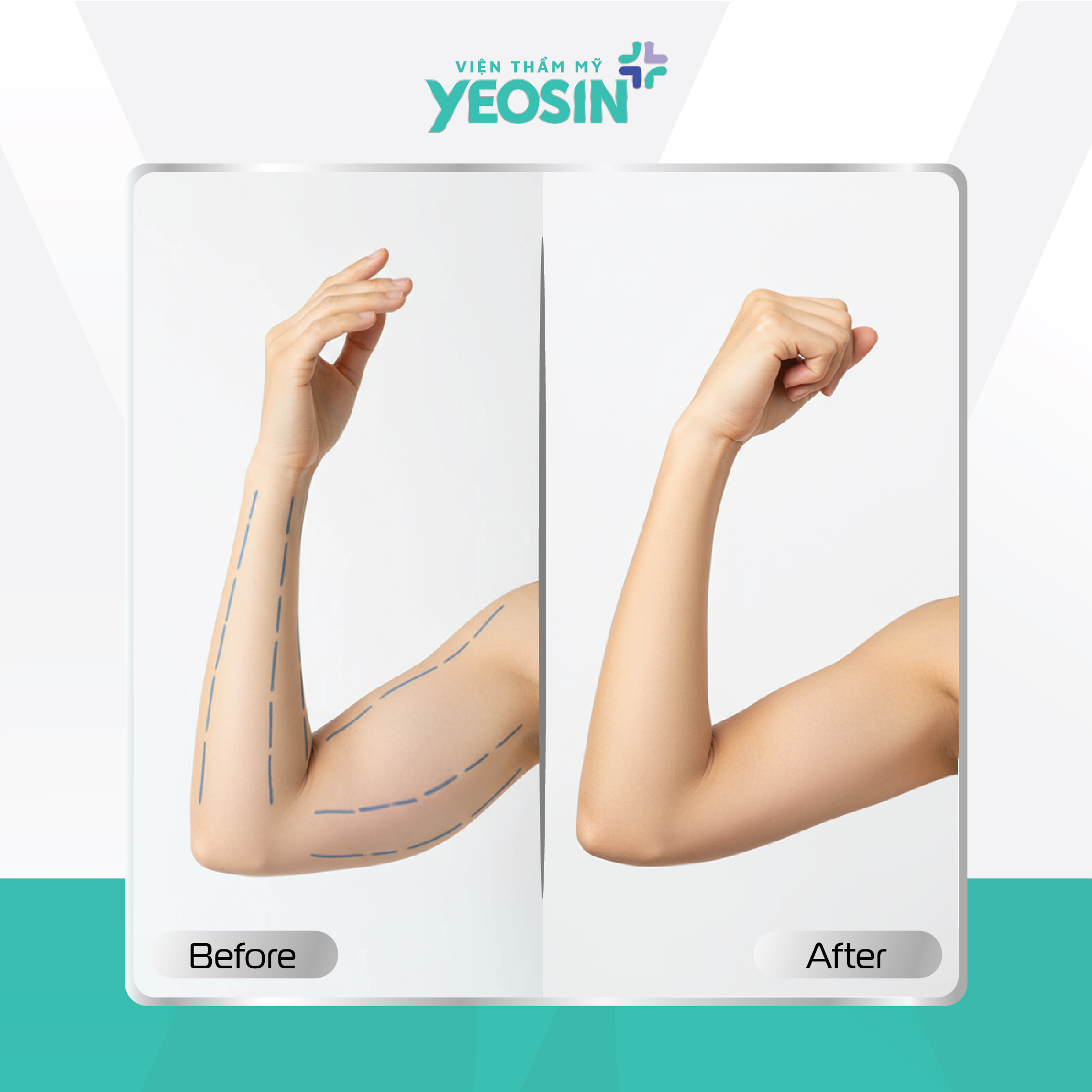 Hút mỡ bắp tay Yeosin