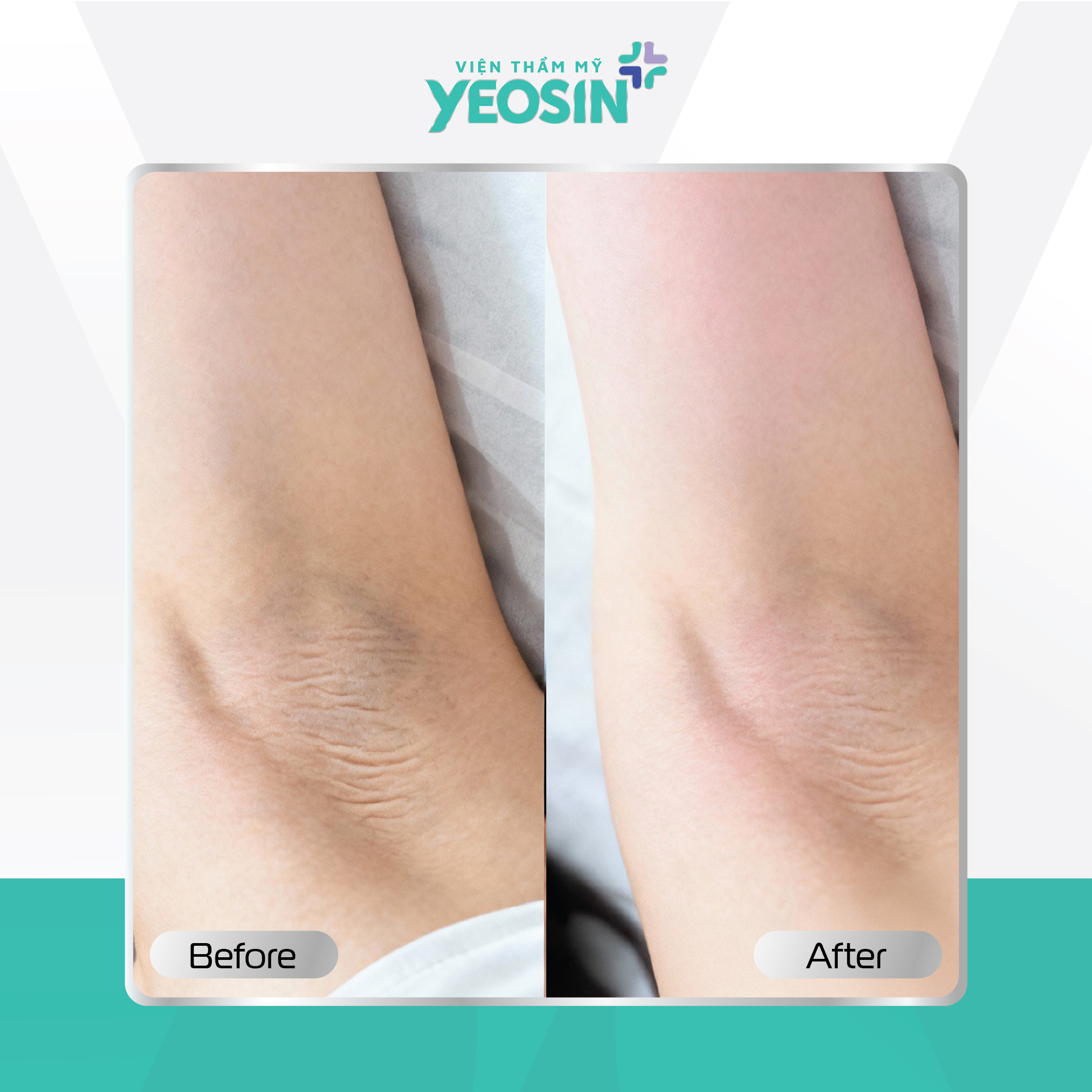 Căng da vùng nách Yeosin