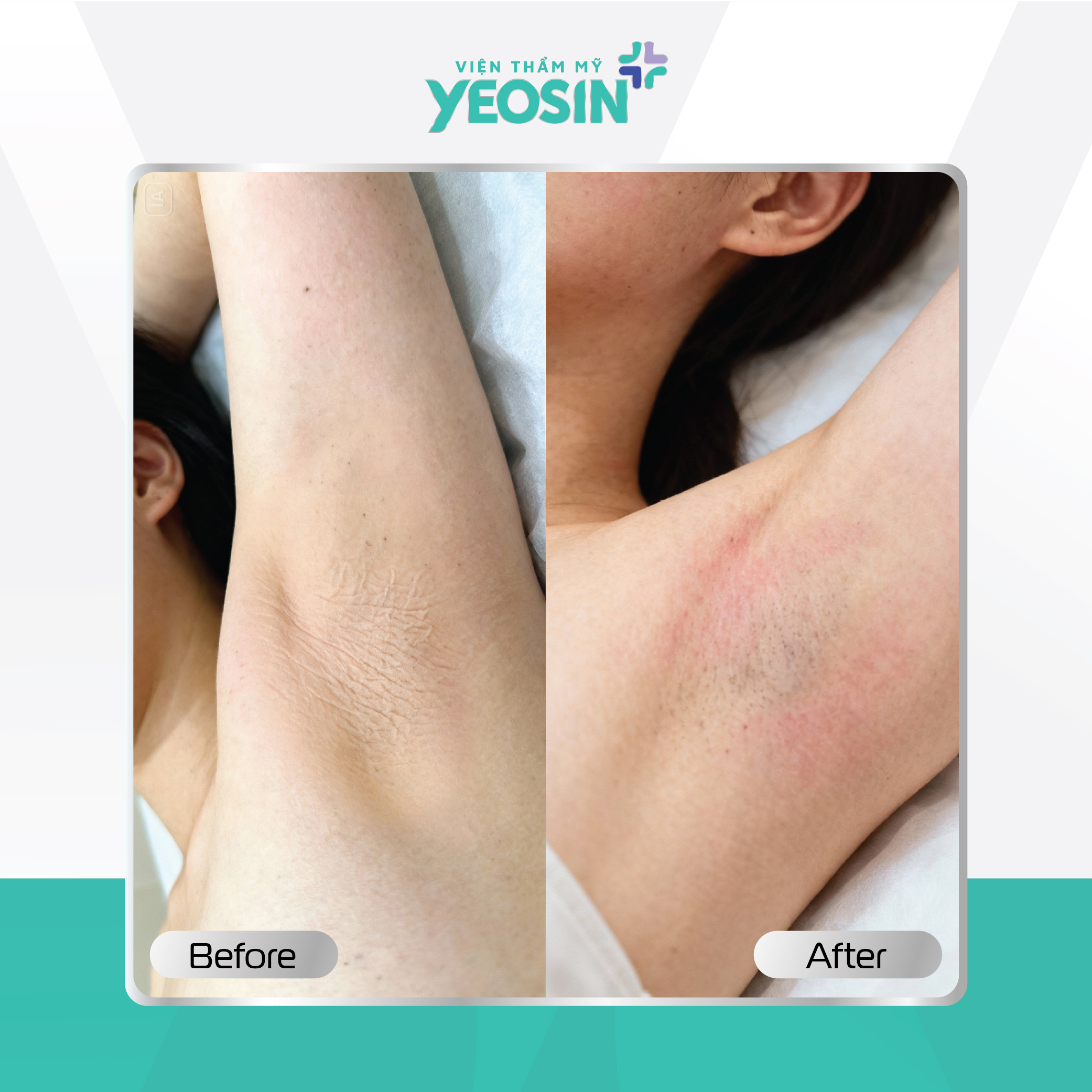 Căng da vùng nách Yeosin