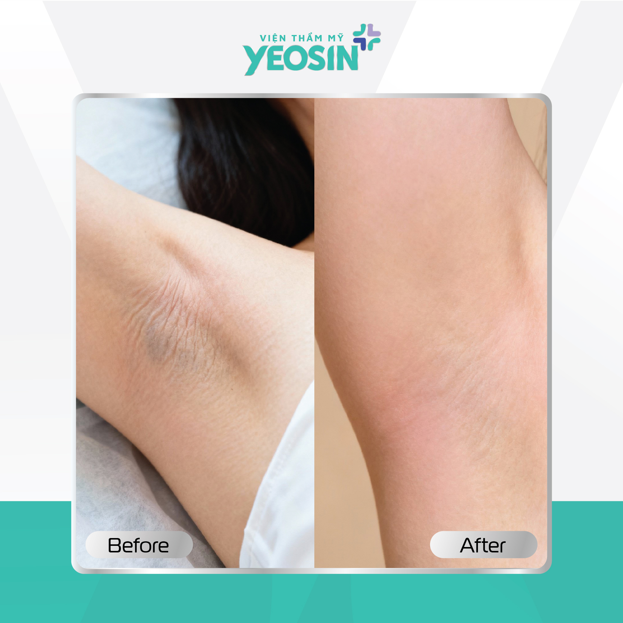 Căng da vùng nách Yeosin