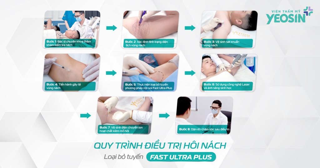 Quy trình thực hiện điều trị hôi nách bằng loại bỏ tuyến mồ hôi công nghệ Fast Ultra Plus