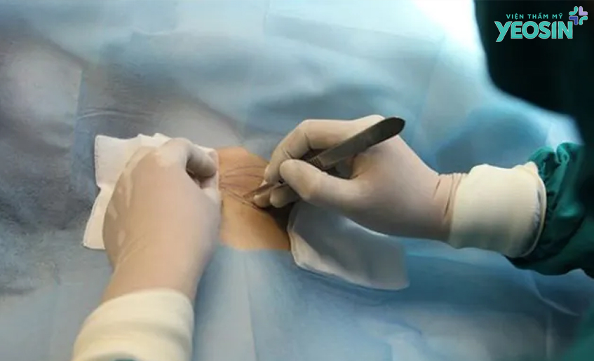 Quy trình thực hiện căng da nách loại bỏ da thừa chảy xệ