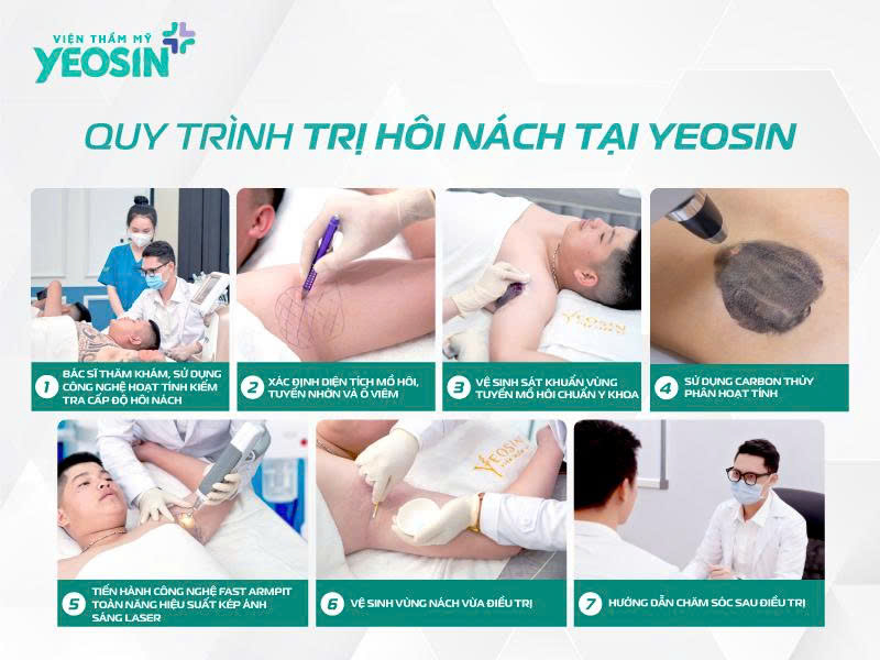 Quy trình điều trị hôi nách bằng laser Fast Armpit