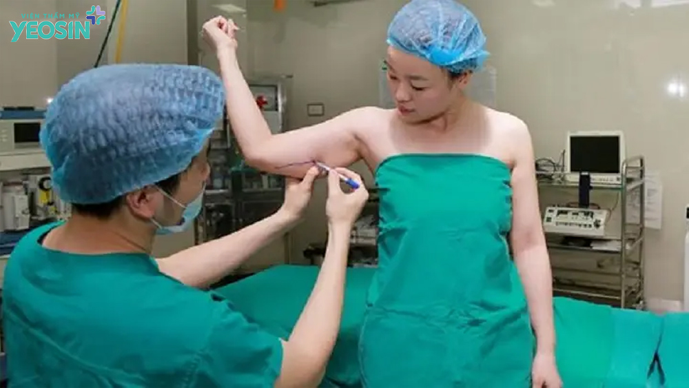 Quy trình hút mỡ vùng bắp tay bằng phương pháp nội soi