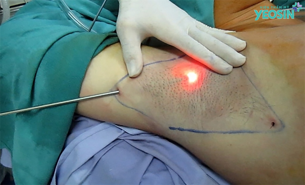 Quy trình hút mỡ vùng nách bằng phương pháp nội soi