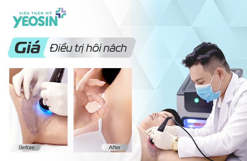 tri hoi nach gia bao nhieu