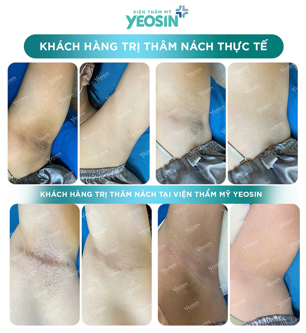 Hình ảnh trước và sau khi trị thâm nách bằng công nghệ Bio Skin tại Yeosin