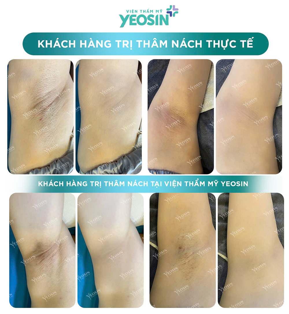 Hình ảnh trước và sau khi trị thâm nách bằng công nghệ Bio Skin tại Yeosin