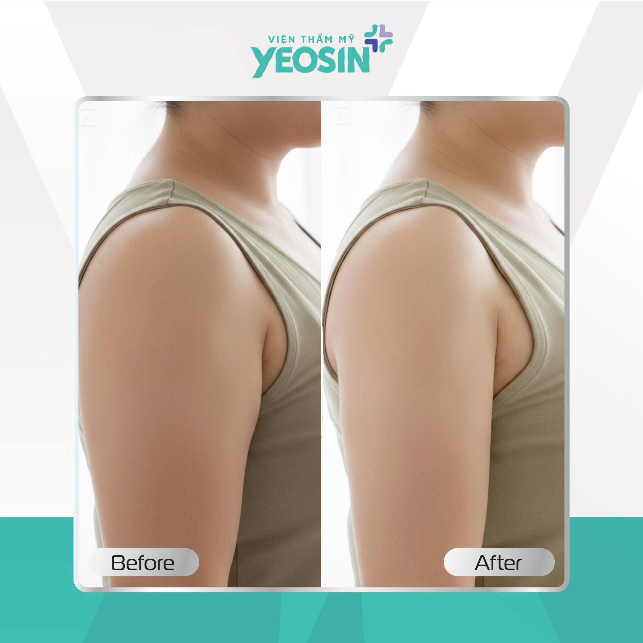 Hủy mỡ vùng nách Yeosin