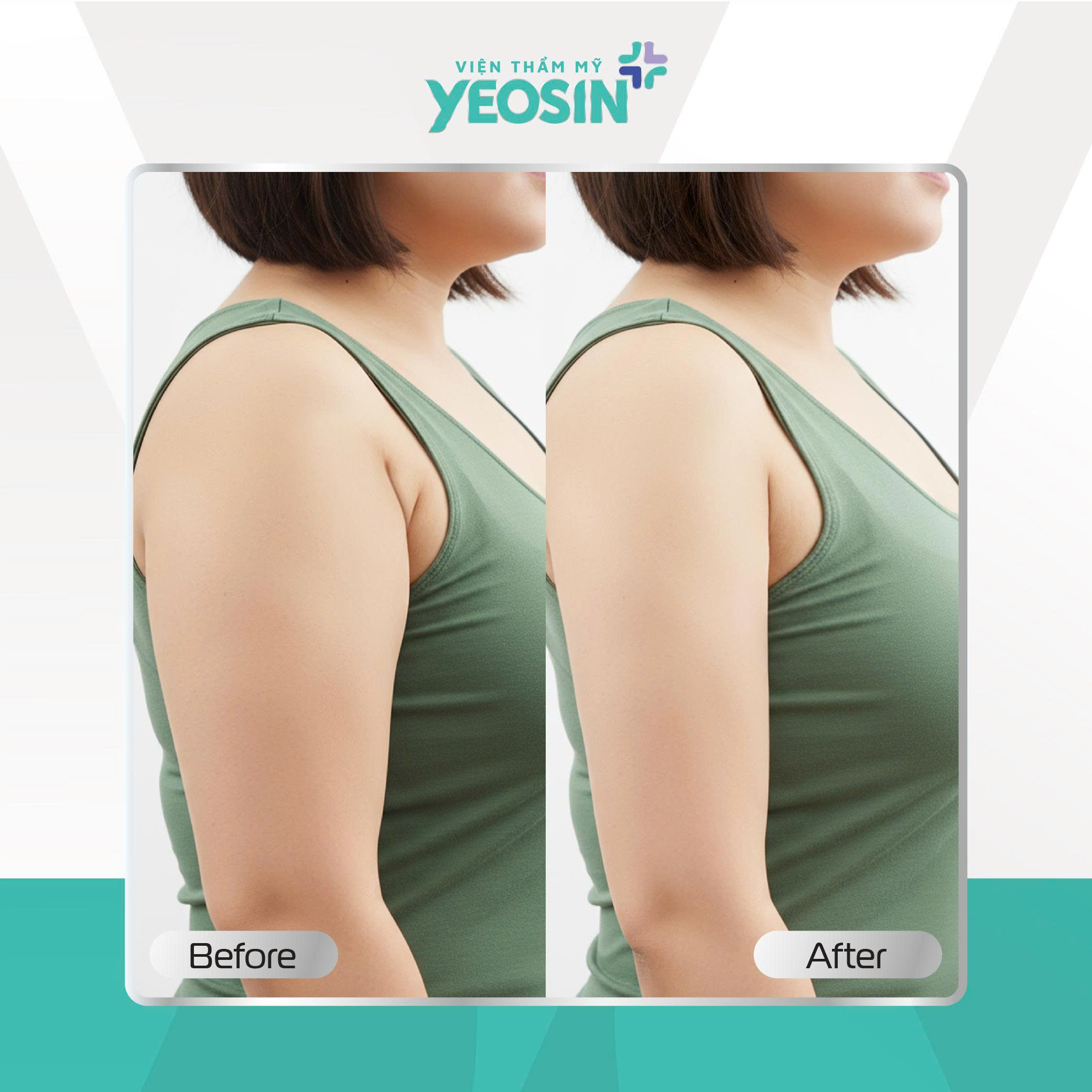 Hủy mỡ vùng nách Yeosin