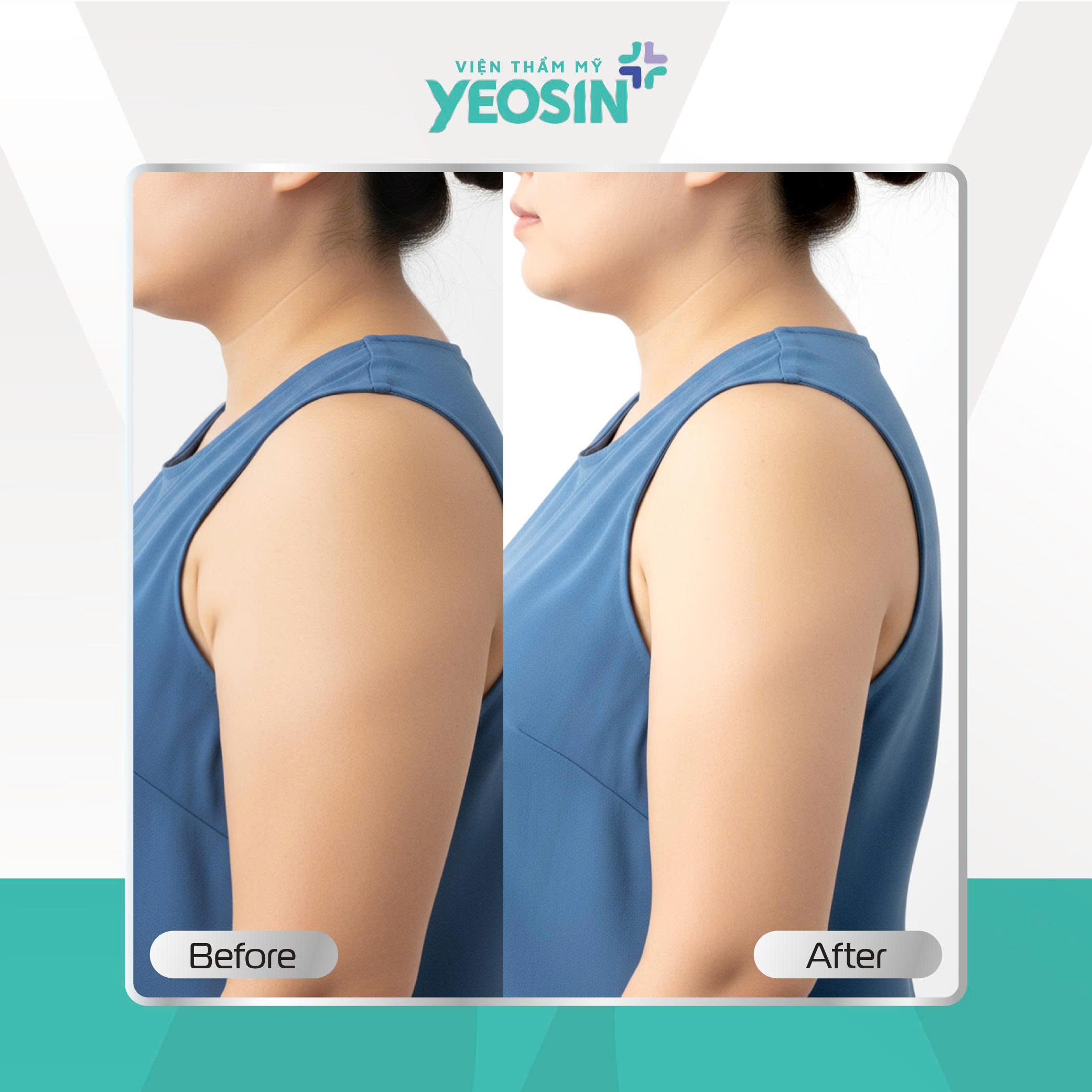 Hủy mỡ vùng nách Yeosin