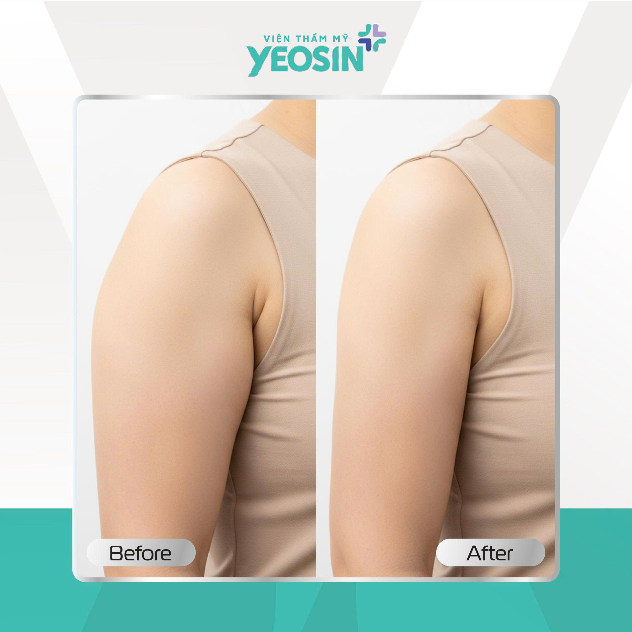 Hủy mỡ vùng nách Yeosin