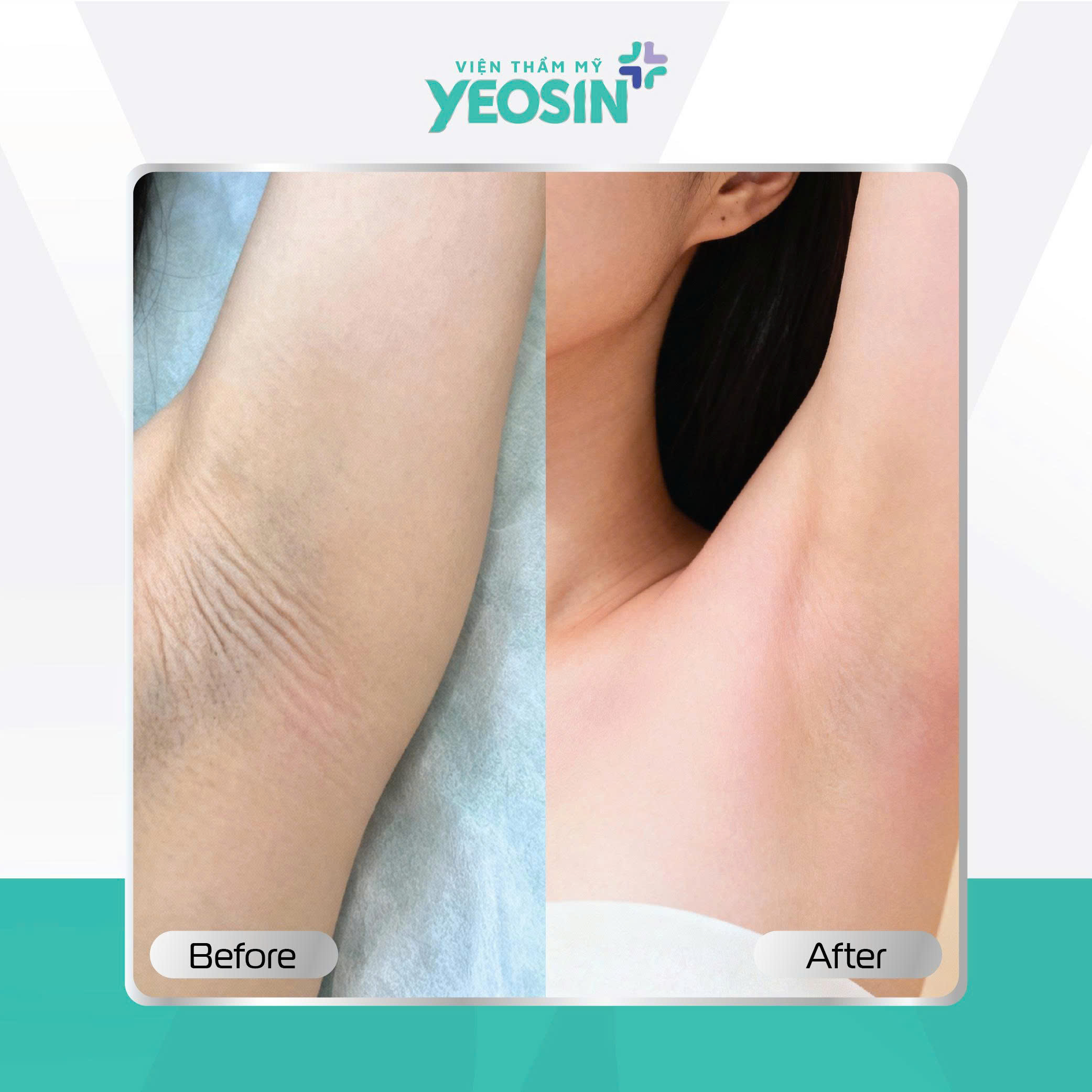 Căng da nách - Giải pháp cải thiện tình trạng da nách chảy xệ 15 z7132763279991 e33db99b980c918482e0fdb0a385e8fb