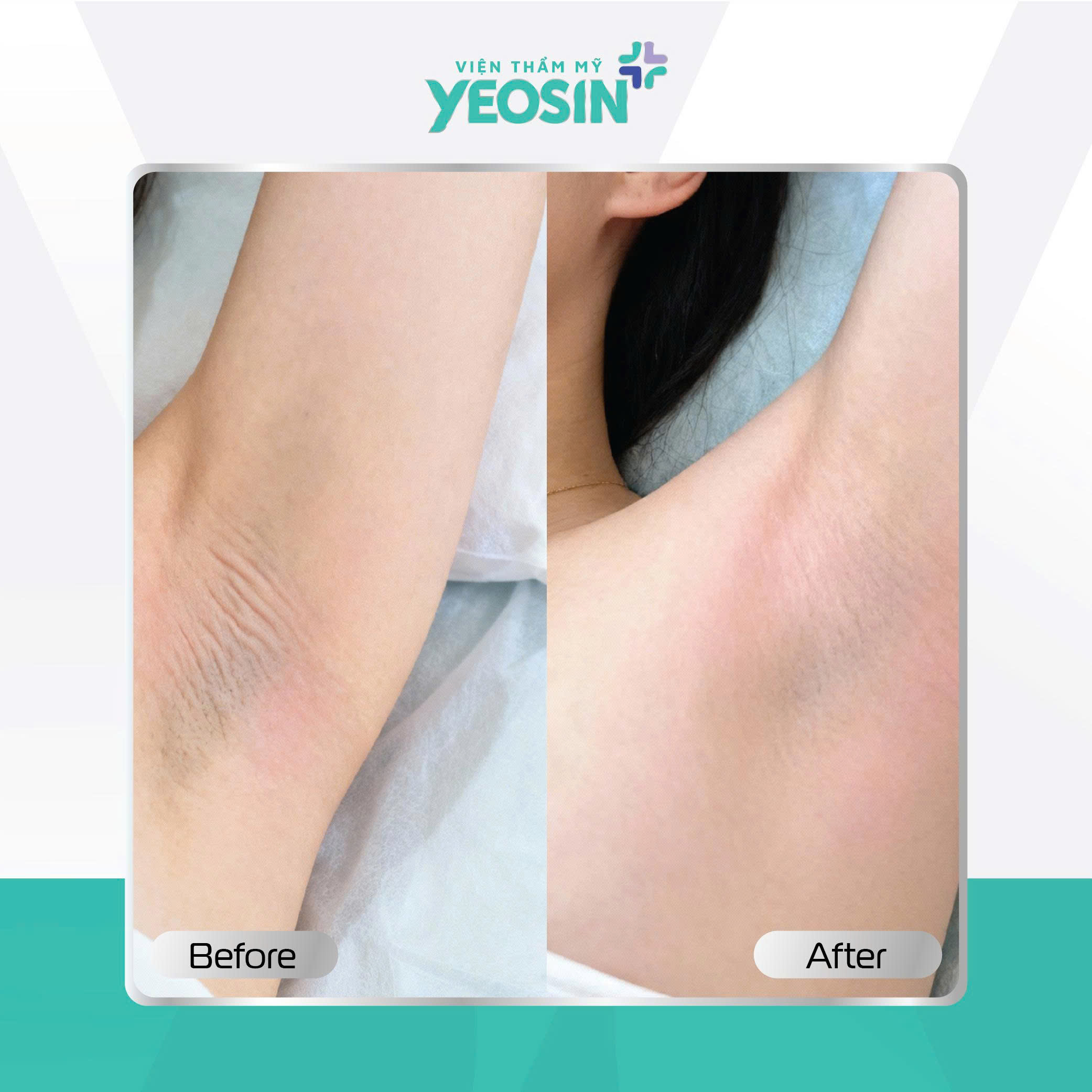 Căng da nách - Giải pháp cải thiện tình trạng da nách chảy xệ 16 z7132763322464 f0071399ff143b0252e3f5929229d144