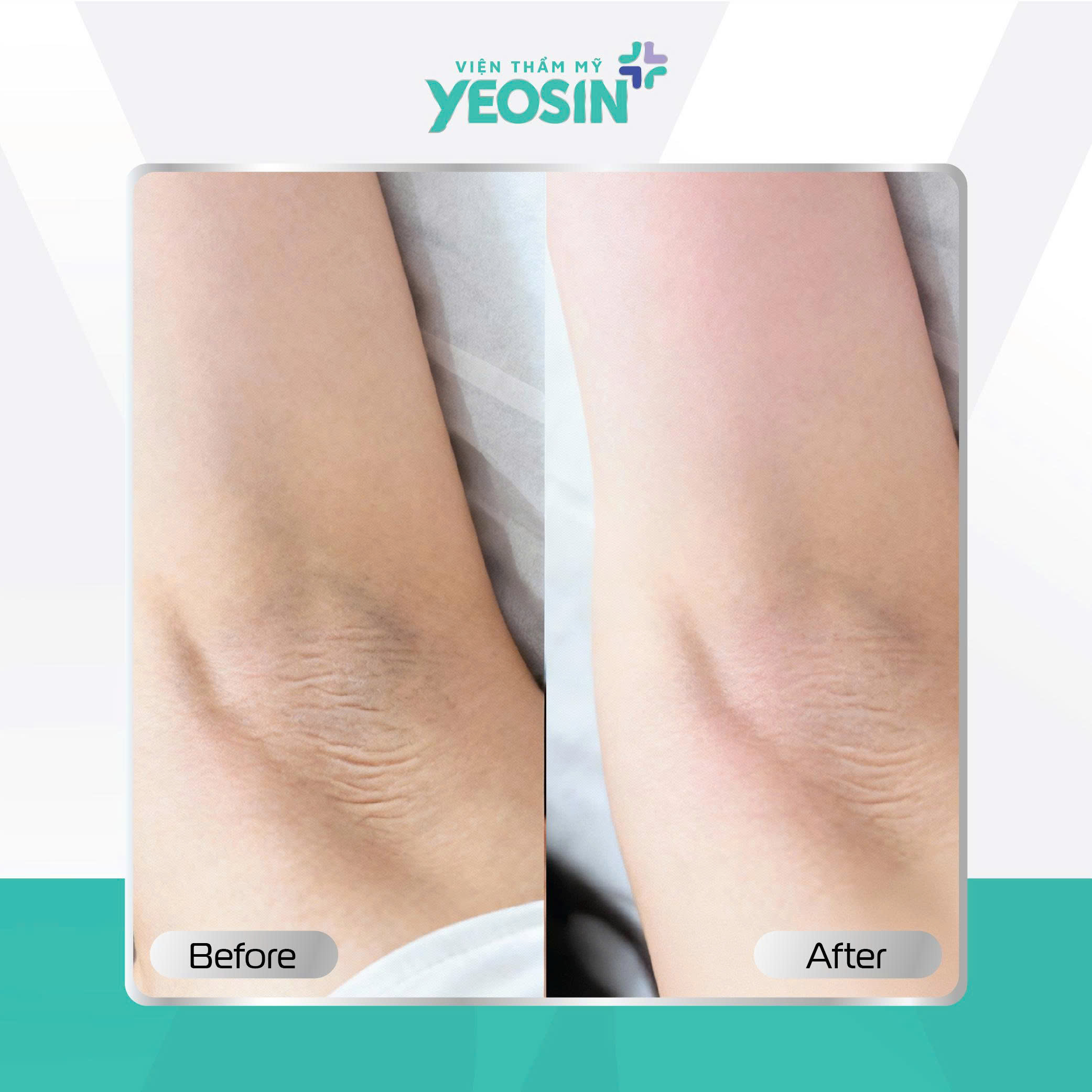 Căng da nách - Giải pháp cải thiện tình trạng da nách chảy xệ 17 z7132763357307 a7b9d06f9f8fe6fd5b4f977d75fe117d