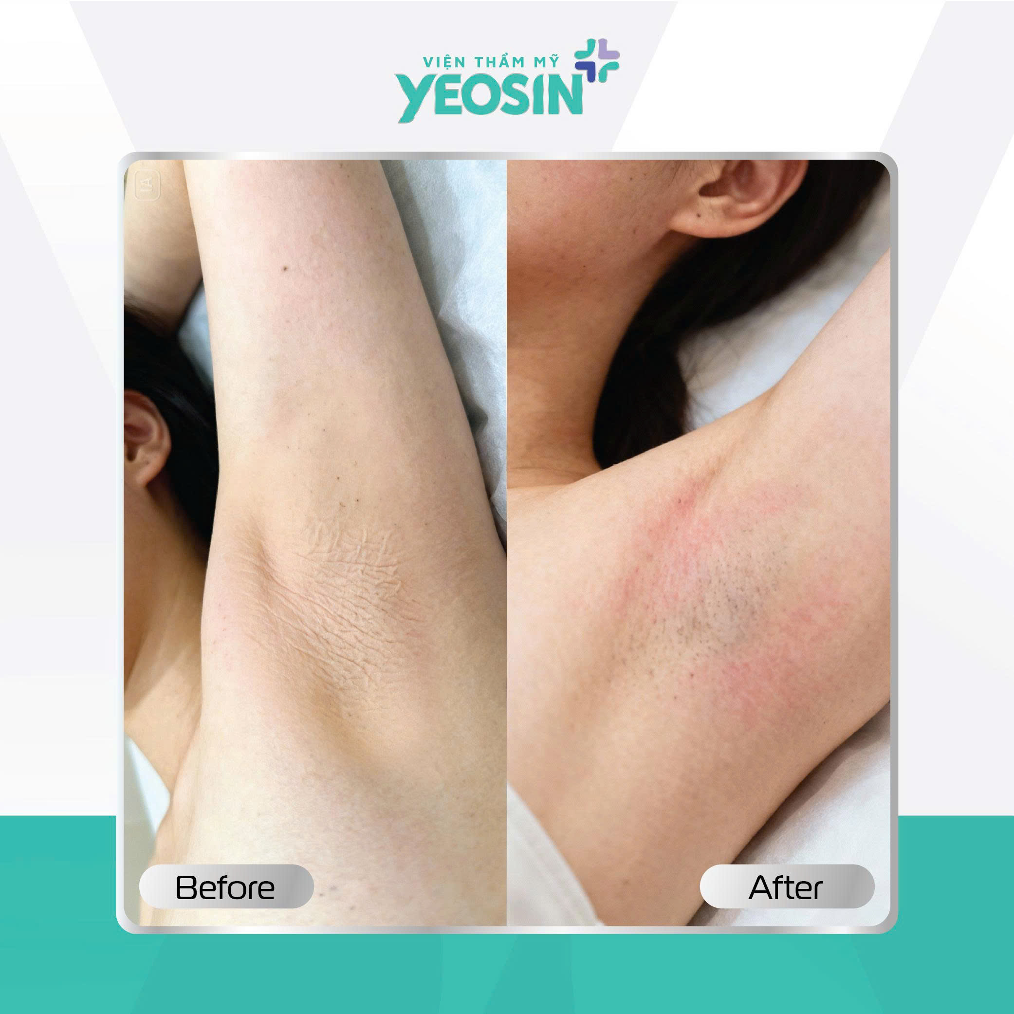 Căng da nách - Giải pháp cải thiện tình trạng da nách chảy xệ 18 Hình ảnh khách hàng căng da nách tại Yeosin