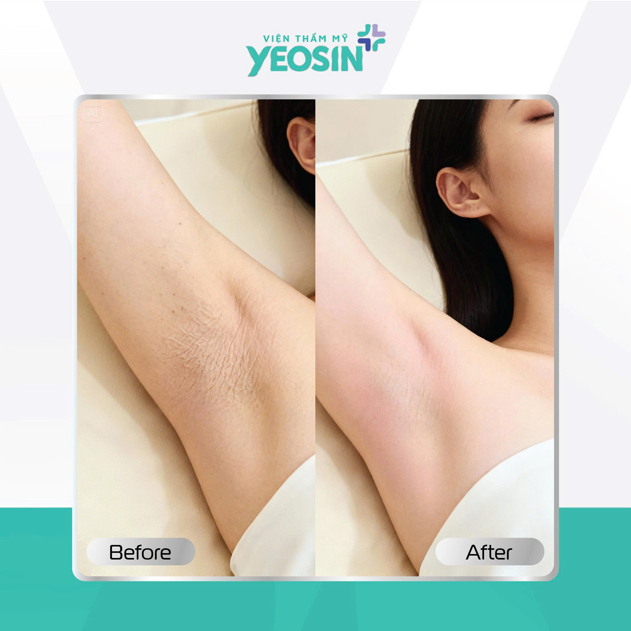 Căng da nách - Giải pháp cải thiện tình trạng da nách chảy xệ 19 Hình ảnh khách hàng căng da nách tại Yeosin