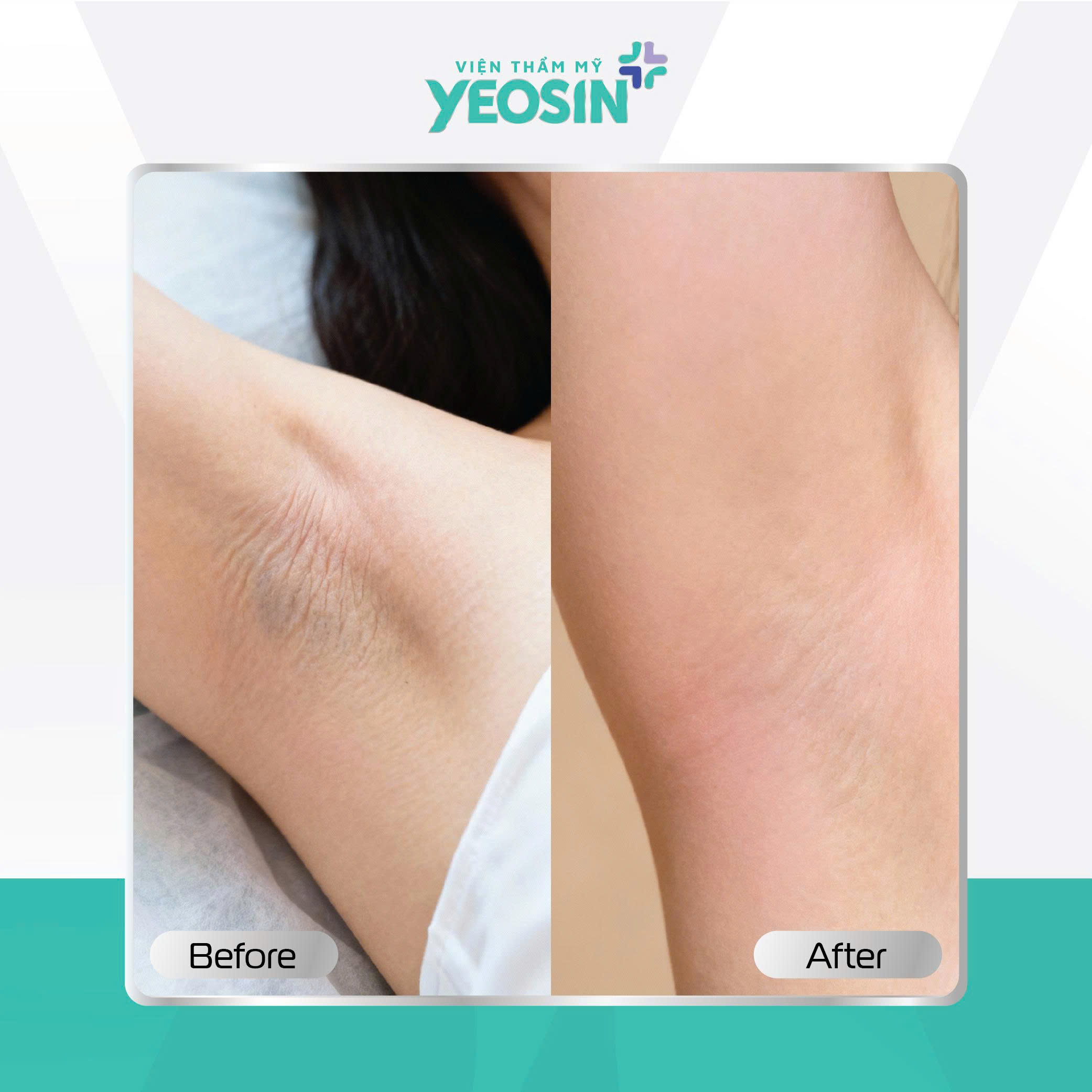 Căng da nách - Giải pháp cải thiện tình trạng da nách chảy xệ 20 Hình ảnh khách hàng căng da nách tại Yeosin