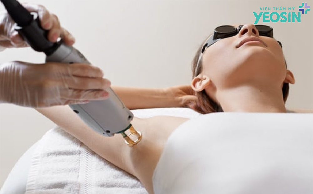 Ưu nhược điểm của phương pháp trị hôi nách Yeosin Ưu nhược điểm của phương pháp trị hôi nách bằng laser